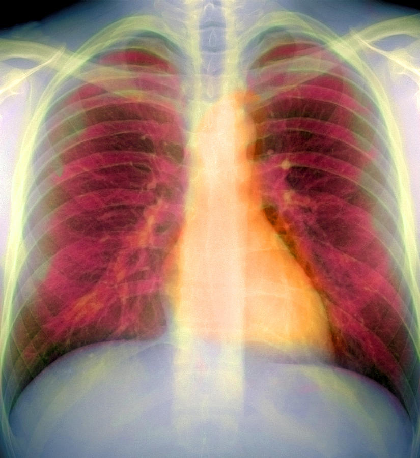 Lungs And Heart, X-ray Photograph By Du Cane Medical Imaging Ltd | Pixels