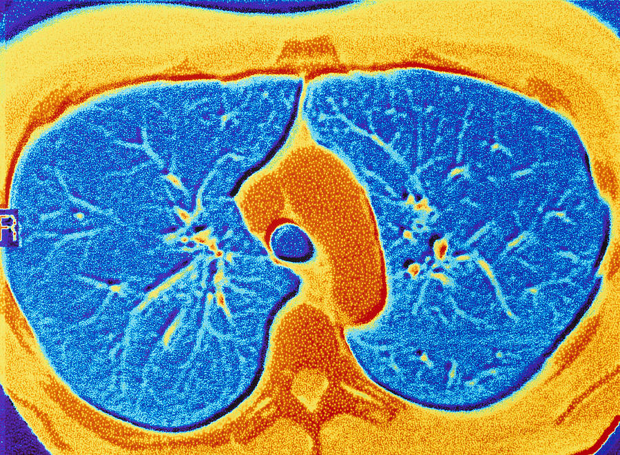 Lungs, Ct Scan Photograph by Pasieka