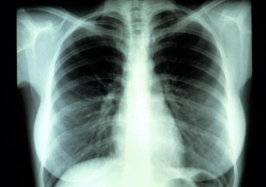 healthy lung xray
