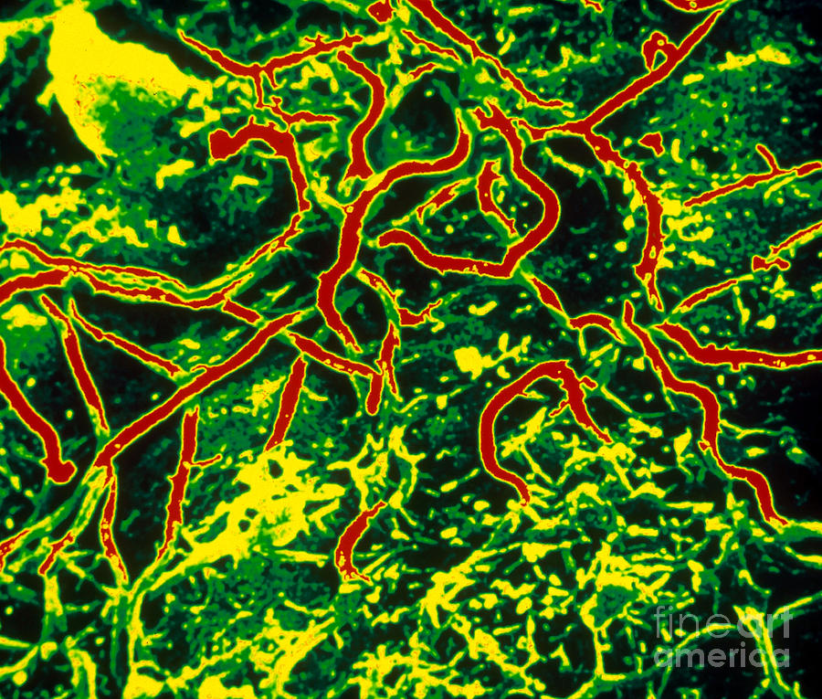 Lyme Disease, Sem Photograph by Science Source