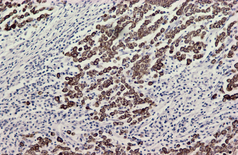 Lymph Node Cancer, Light Micrograph by Science Photo Library
