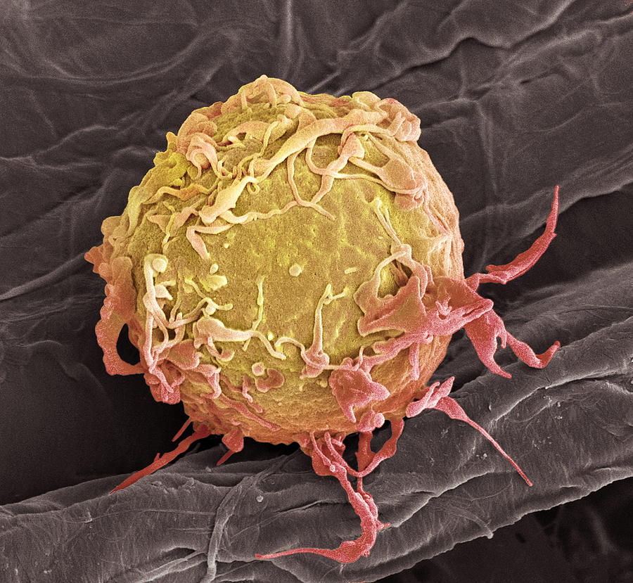 Cell Photograph - Lymphoma Cancer Cell, Sem by Steve Gschmeissner