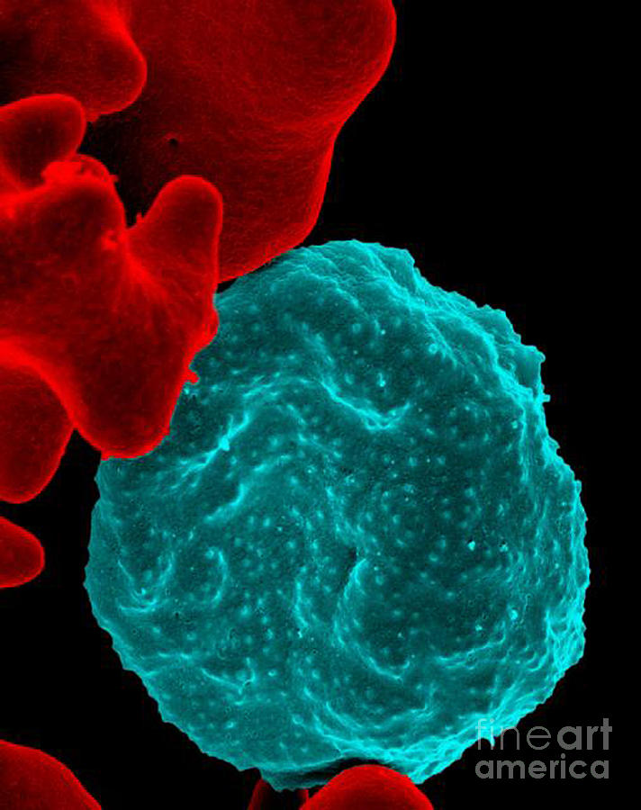 Malaria-infected Red Blood Cell, Sem Photograph by Science Source