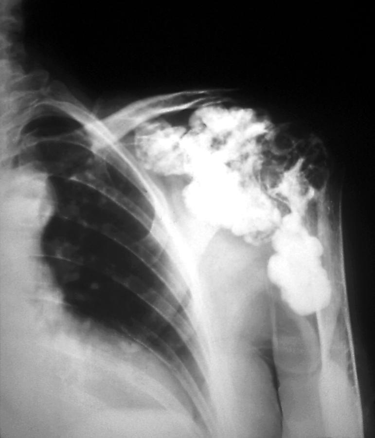 Black And White Photograph - Melorheostosis Of The Shoulder, X-ray by Zephyr