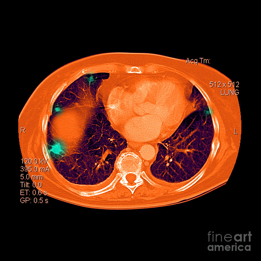 Metastatic Cancer Of The Lungs Photograph by Medical Body Scans