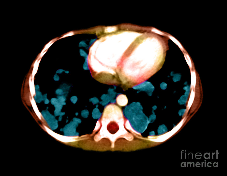Metastatic Disease Of The Lungs Photograph by Medical Body Scans