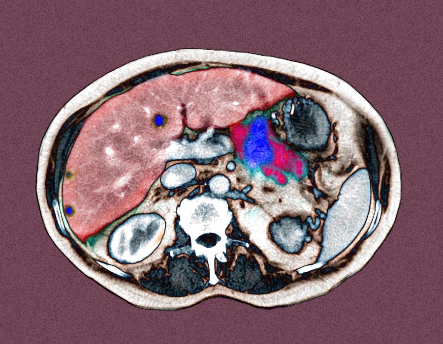 Can You See Rectal Cancer On A Ct Scan