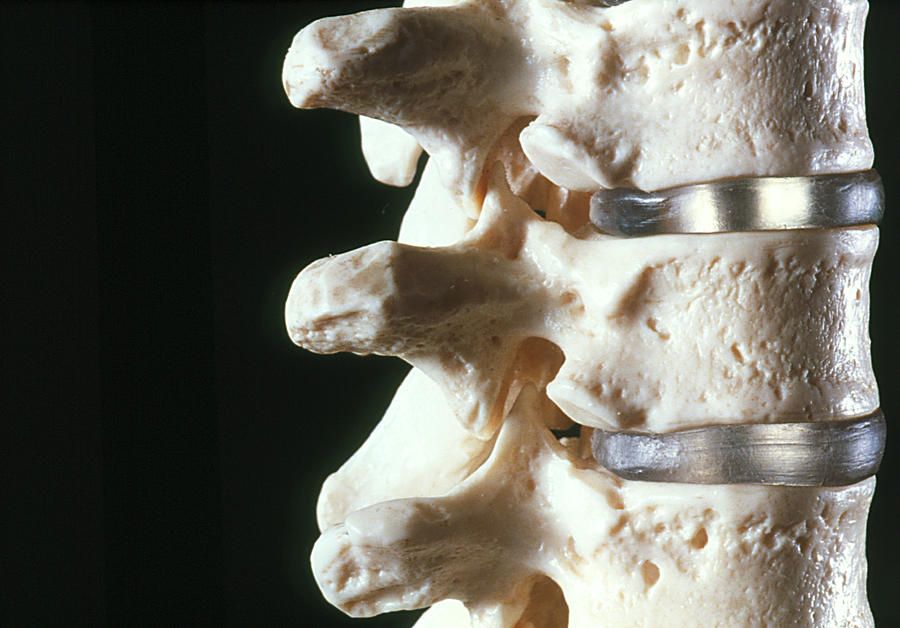 Model Of Three Vertebrae And Intervertebral Discs Photograph by Mike ...