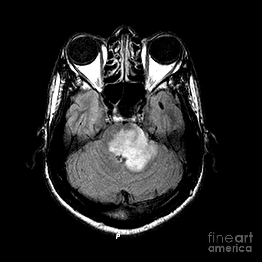 Mri Of Acute Ms Photograph by Medical Body Scans