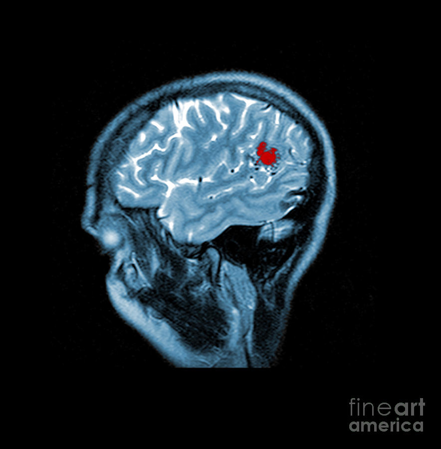 Mri Of Brain Avm Photograph by Medical Body Scans