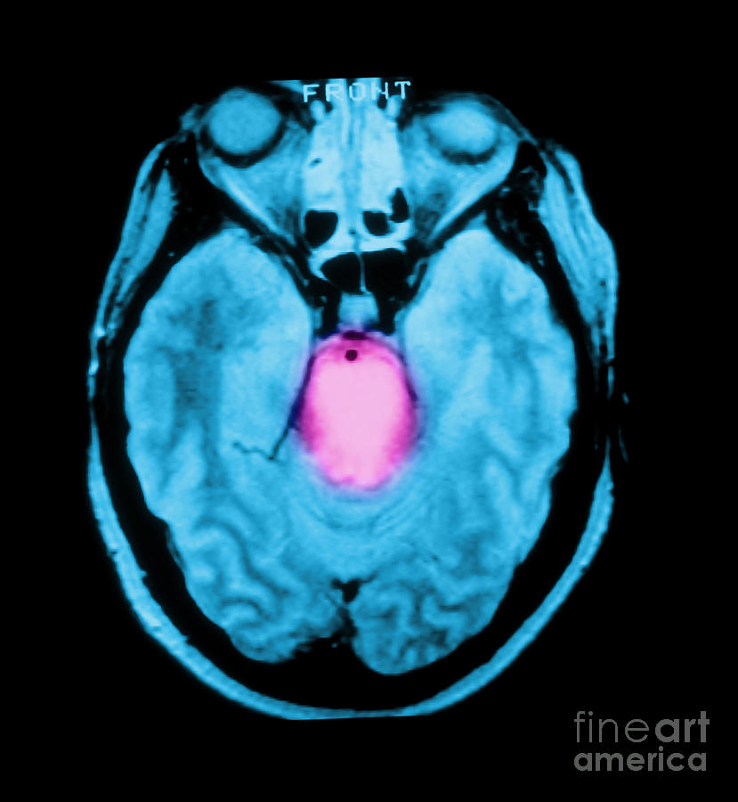Mri Of Brainstem Glioma Photograph by Medical Body Scans