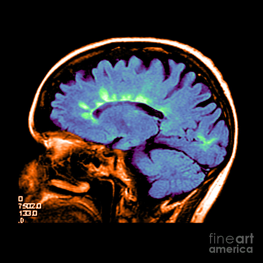Abnormal Mri Of Brain Photograph - Mri Of Multiple Sclerosis by Medical Body Scans