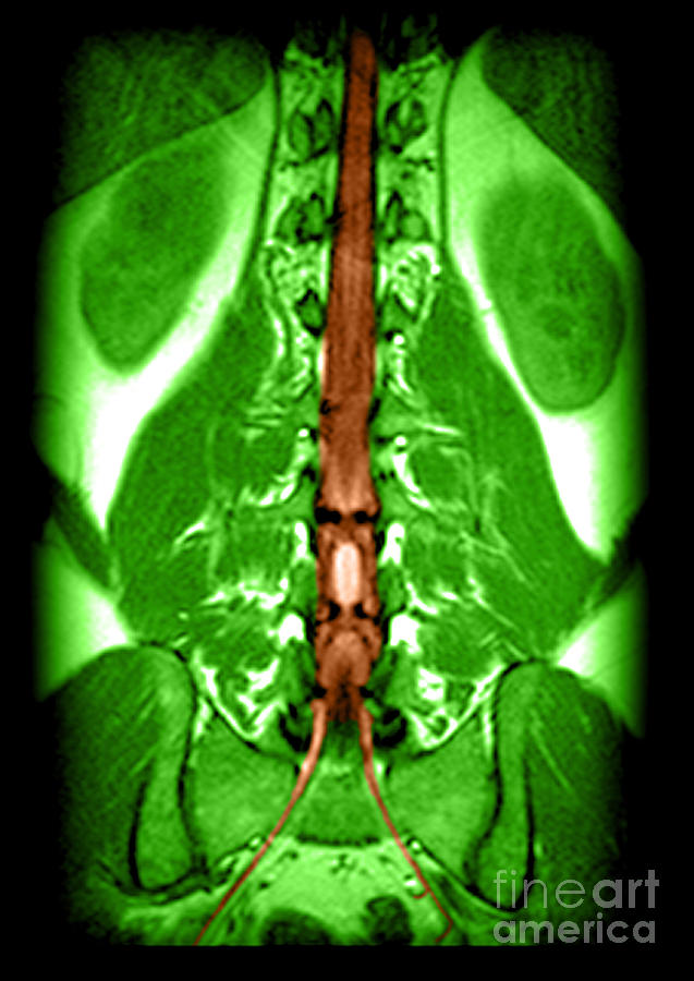 Mri Of Spinal Cord And Nerve Roots Photograph by Medical Body Scans