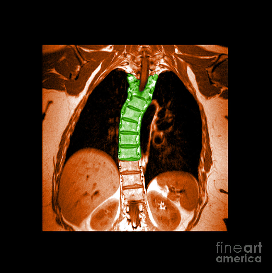 Mri Of Thoracic Scoliosis Photograph by Medical Body Scans