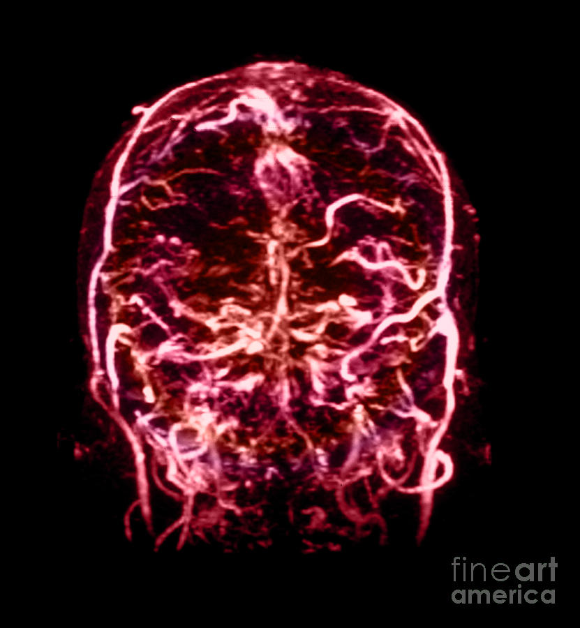Abnormal Mri Brain Photograph - Mri Of Venogram Of Dural Sinus by Medical Body Scans