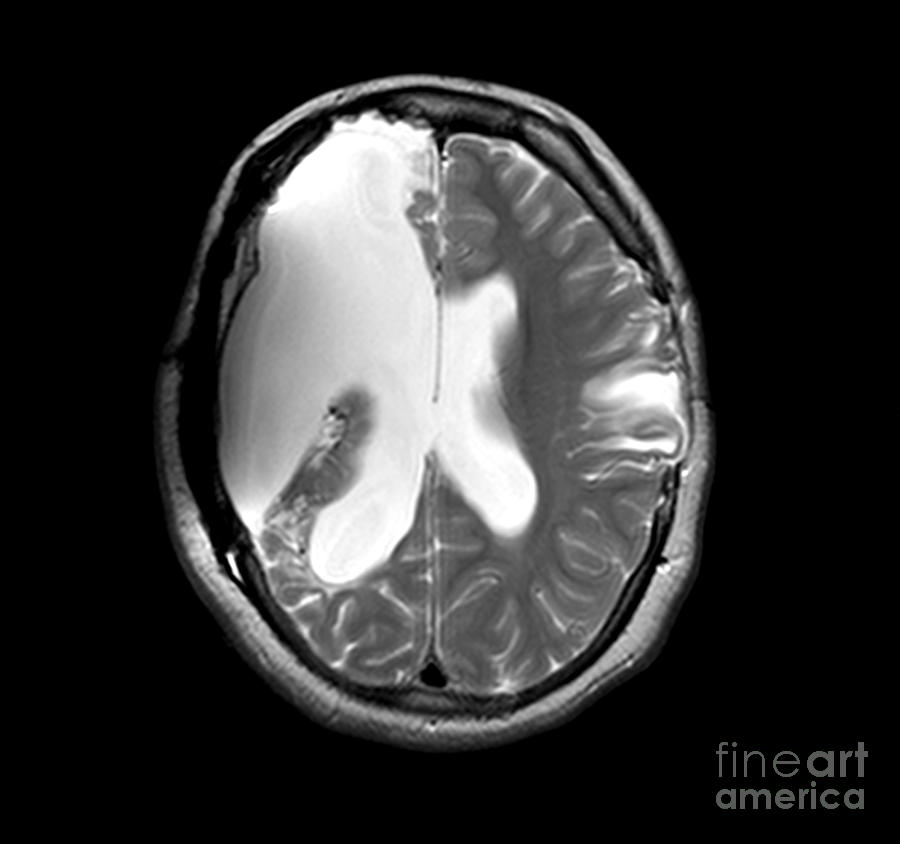 Mri Shows Near Total Hemispherectomy Photograph by Medical Body Scans