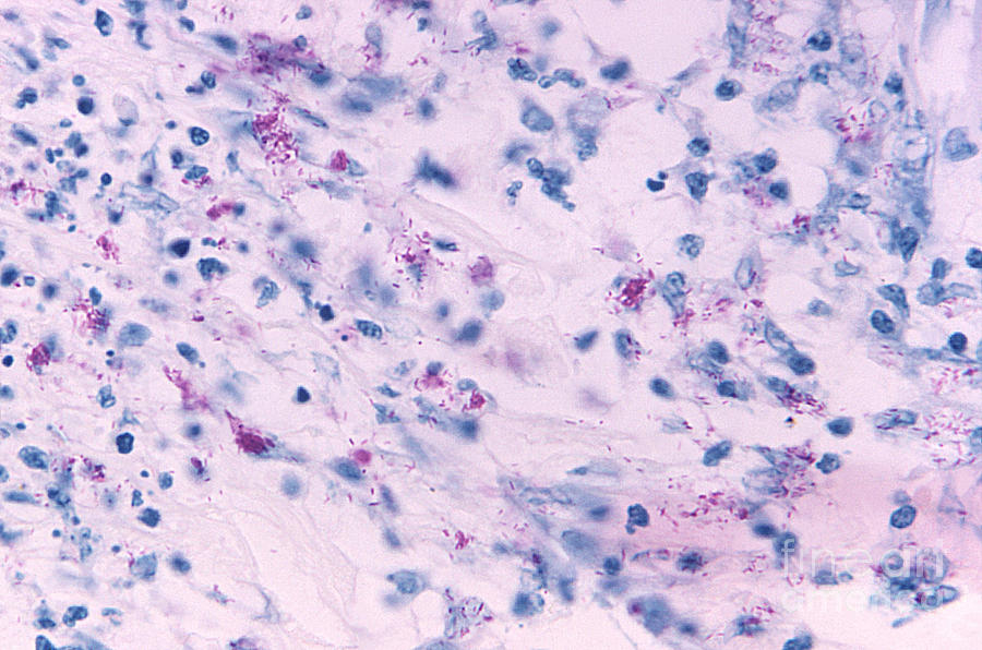 Mycobacterial Skin Infection, Lm Photograph by Science Source