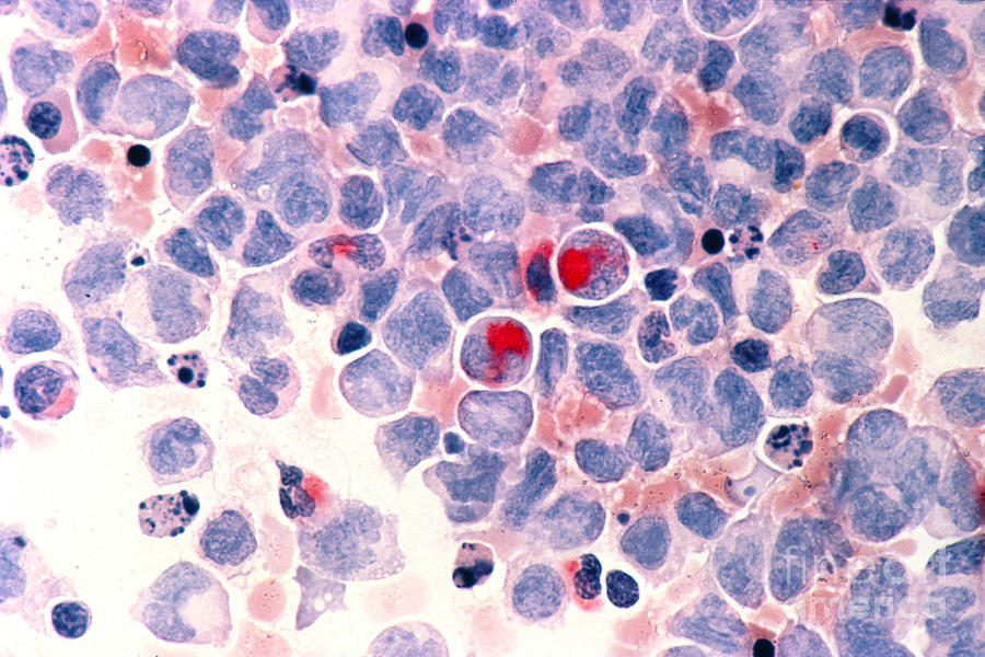 Myelocytic Leukemia Photograph - Myelocytic Leukemia by Science Source