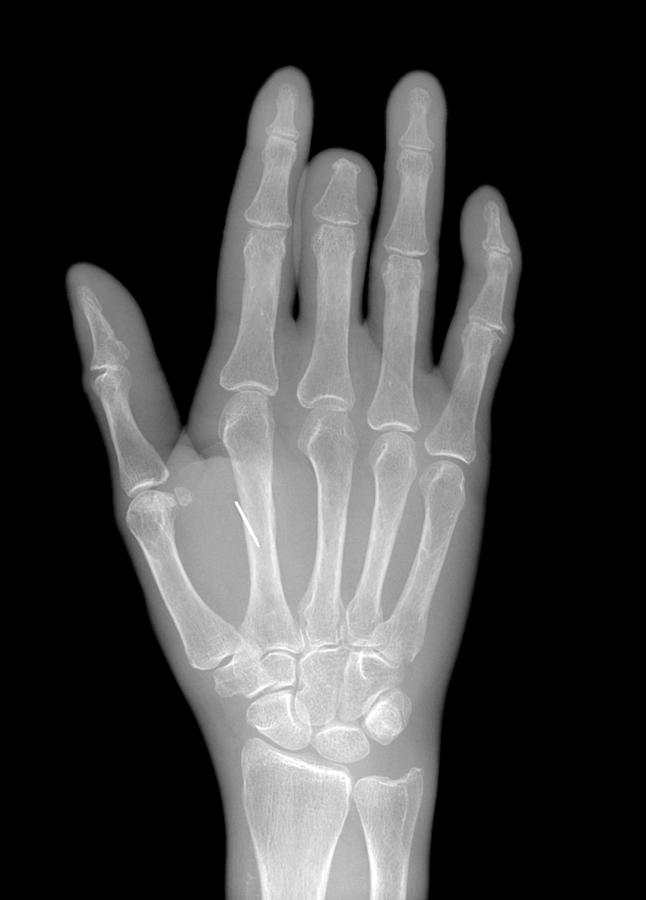 Needle Stuck In Hand, Xray Photograph by Du Cane Medical Imaging Ltd Pixels