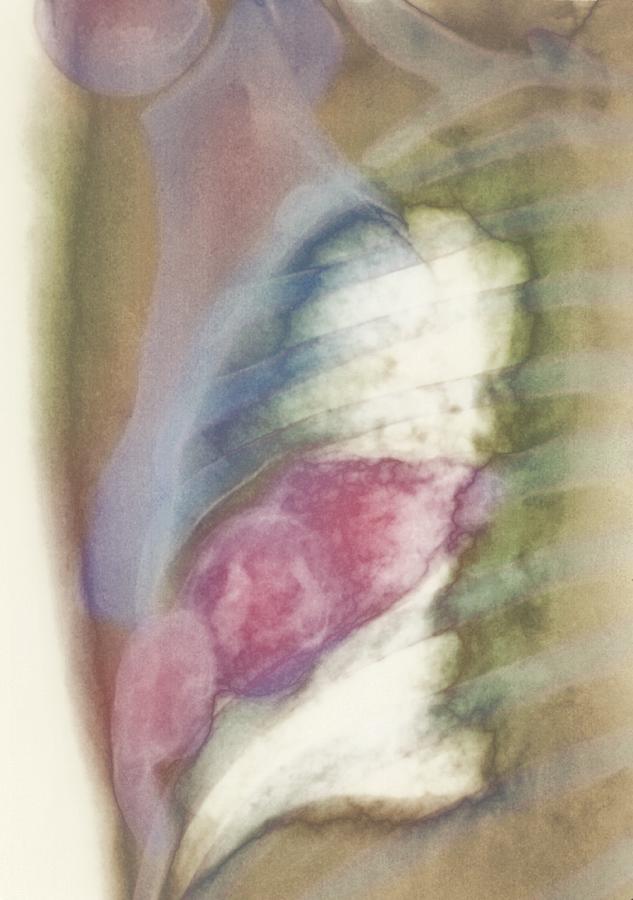 Neurofibroma Photograph - Neurofibroma Tumour, X-ray by Cnri
