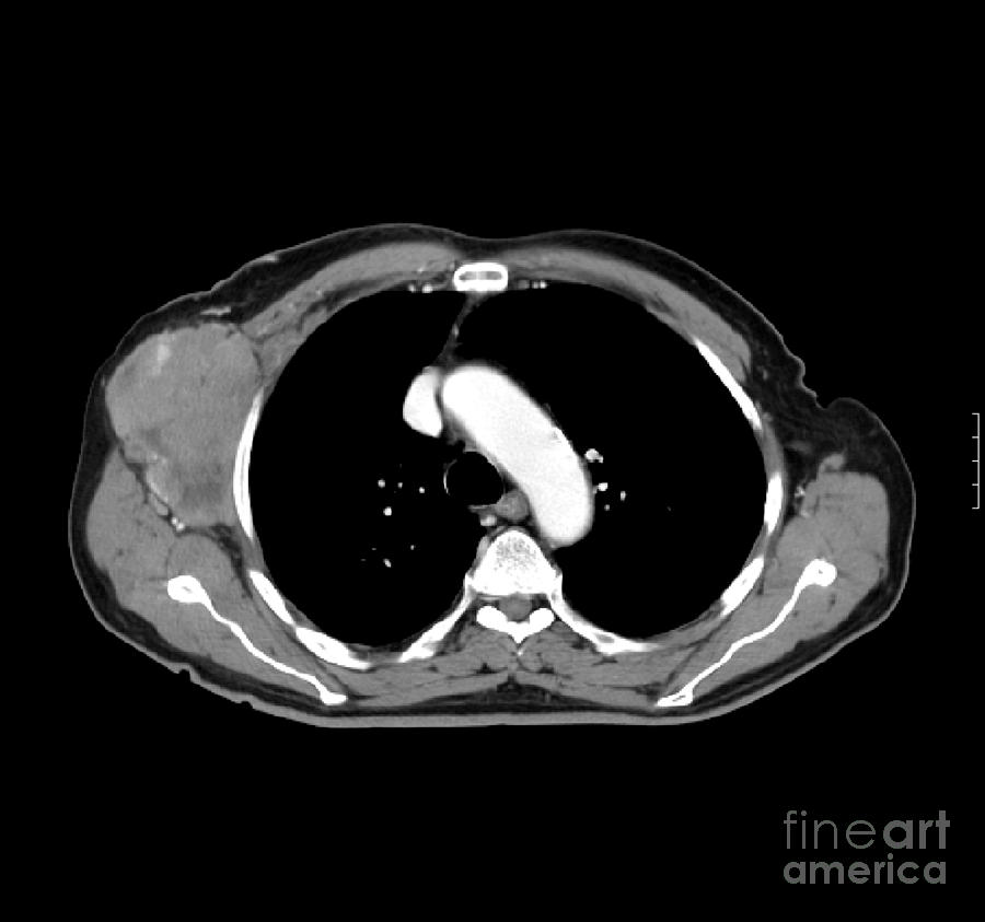 Non-hodgkins Lymphoma Photograph by Medical Body Scans | Fine Art America