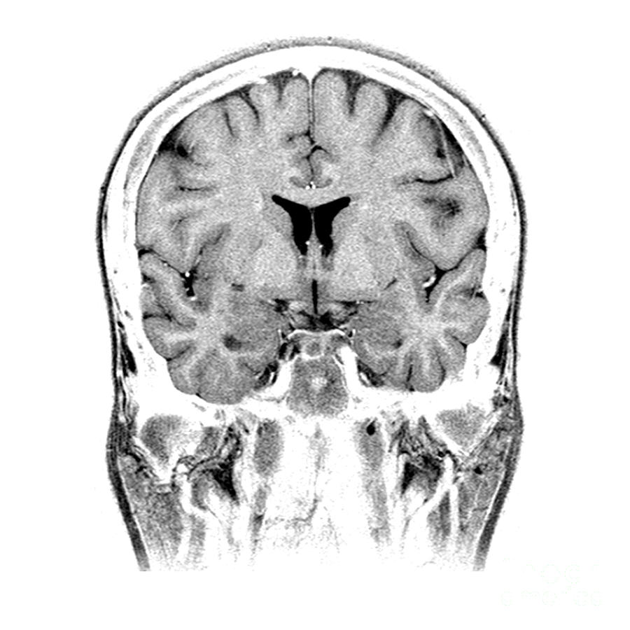Normal Coronal Mri Of The Brain Photograph by Medical Body Scans
