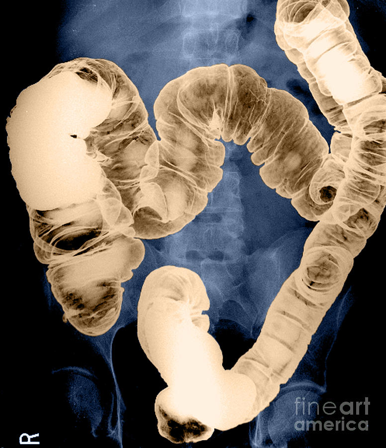 Normal Double Contrast Barium Enema Photograph by Medical Body Scans