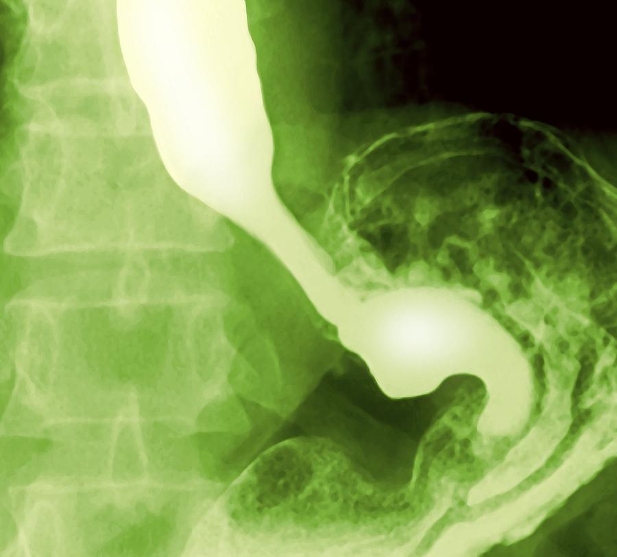 Stomach Photograph - Normal Oesophagus And Stomach, X-ray by Miriam Maslo