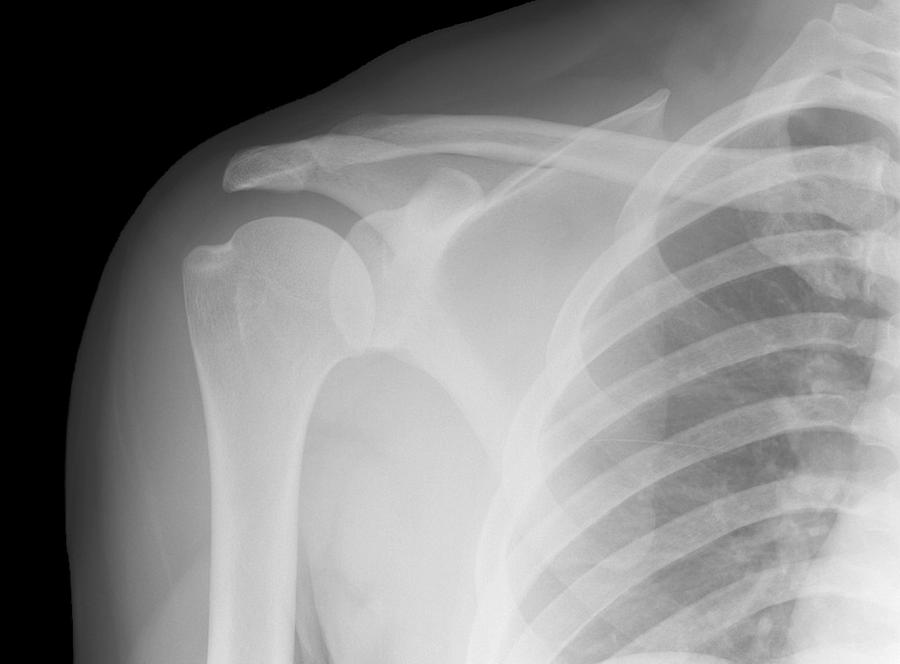 Normal Shoulder, X-ray Photograph by Du Cane Medical Imaging Ltd
