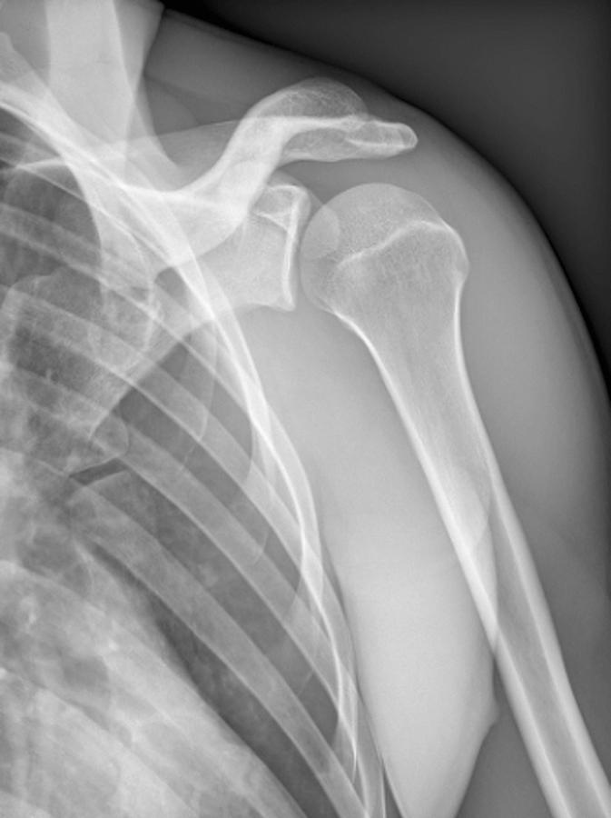 Skeleton Photograph - Normal Shoulder, X-ray by Zephyr