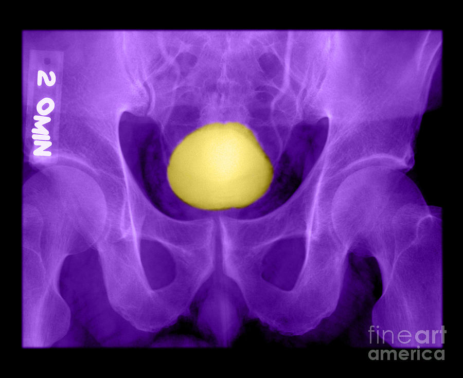 Normal Xray Of Urinary Bladder Photograph by Medical Body Scans