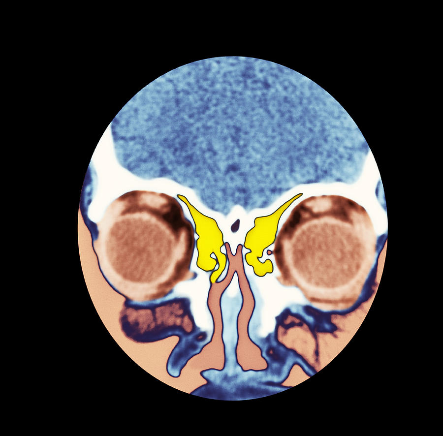 ct scan of nose