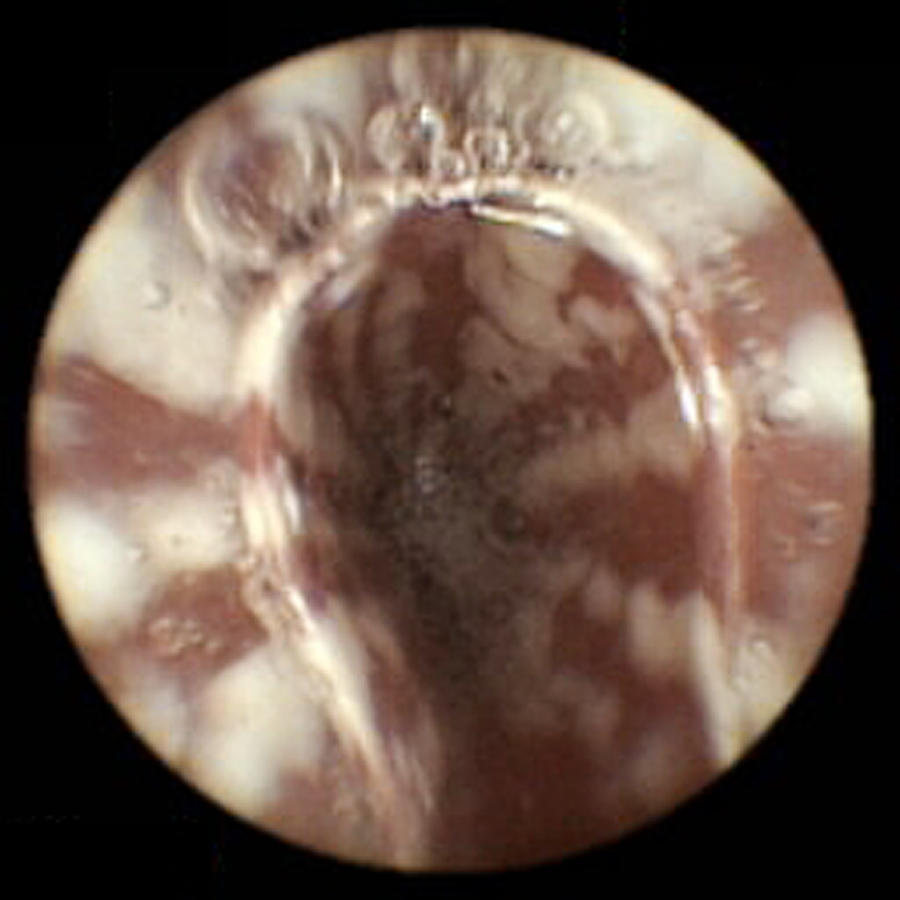 Candida Albicans Photograph - Oesophageal Candidiasis, Pill Camera View by David M. Martin, Md
