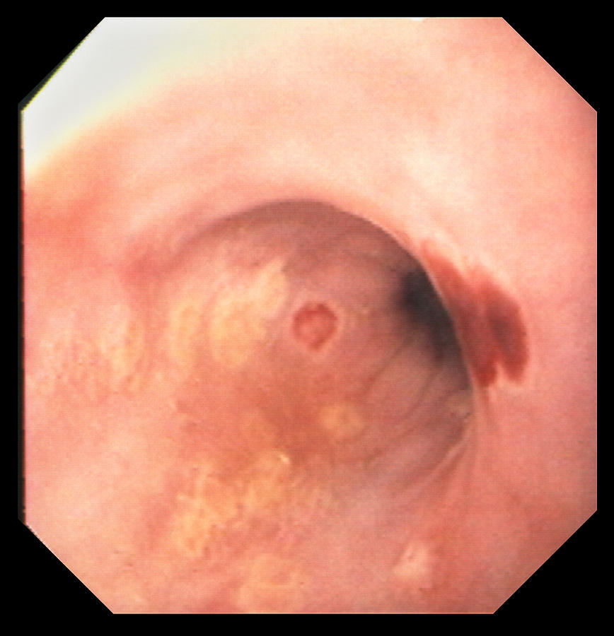 Medicine Photograph - Oesophageal Herpes In Aids by David M. Martin, Md