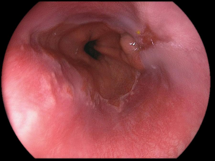 Endoscopy Photograph - Oesophagitis Grade A From Reflux by Gastrolab