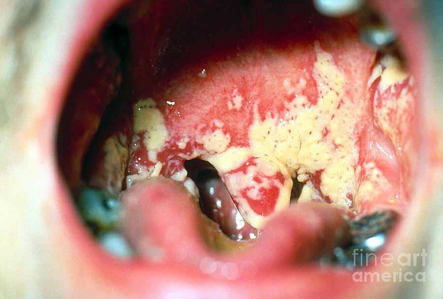 Oral Thrush Photograph by Science Source
