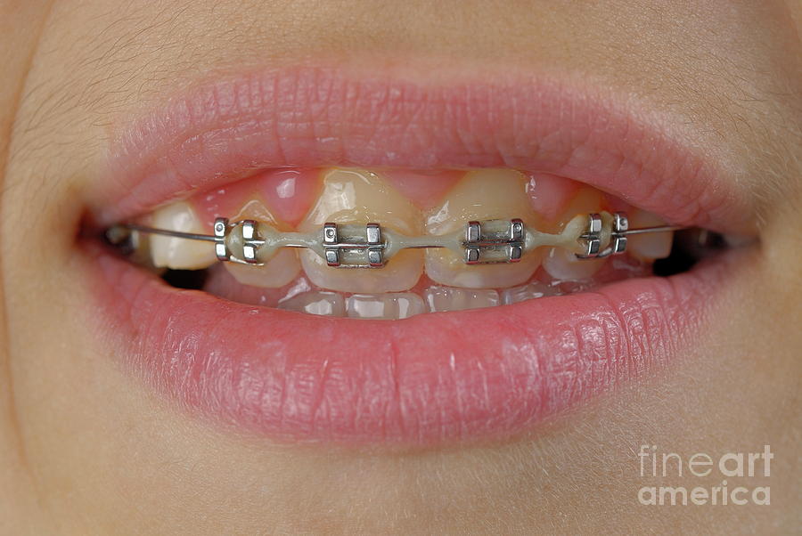 Portrait Photograph - Orthodontic braces on teeth by Sami Sarkis