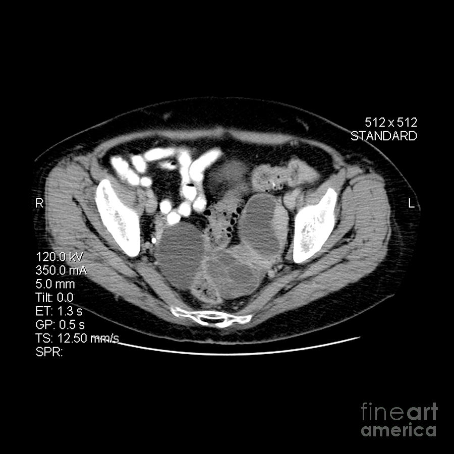 Ovarian Cancer Photograph by Medical Body Scans
