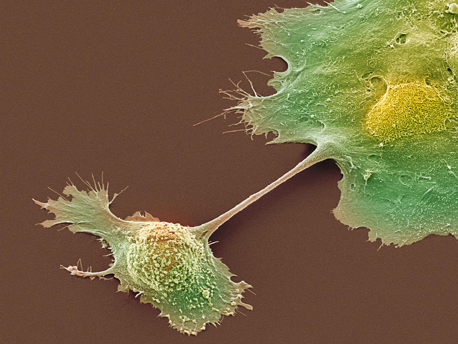 Cancer Photograph - Pancreatic Cancer Cells, Sem by Steve Gschmeissner