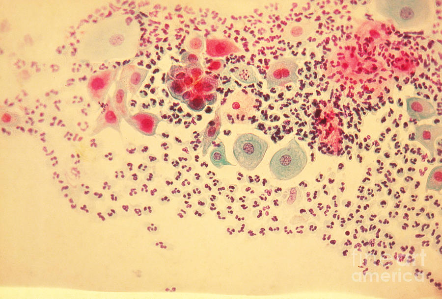 Pap Smear Photograph by AFIP / Science Source