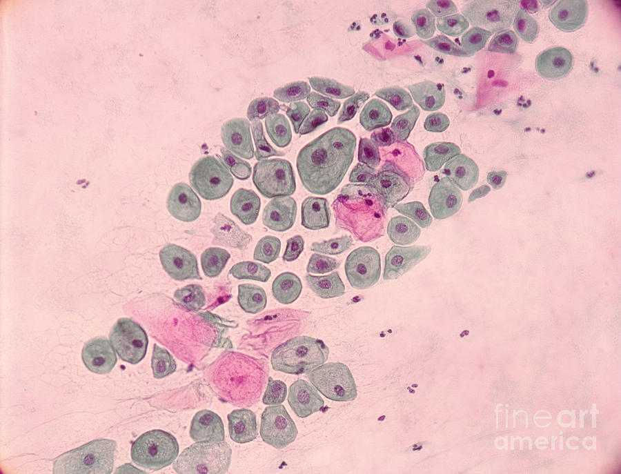 Pap Smear, Cancer Photograph by Science Source