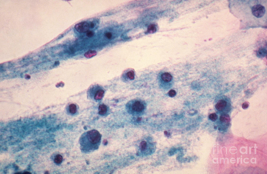 Pap Smear, Nucleated Yeast Photograph by Science Source