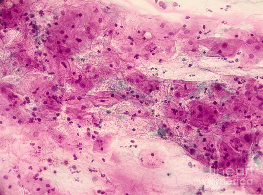 Trichomoniasis Photograph - Pap Smear Showing Trichomonas Vaginalis by Science Source