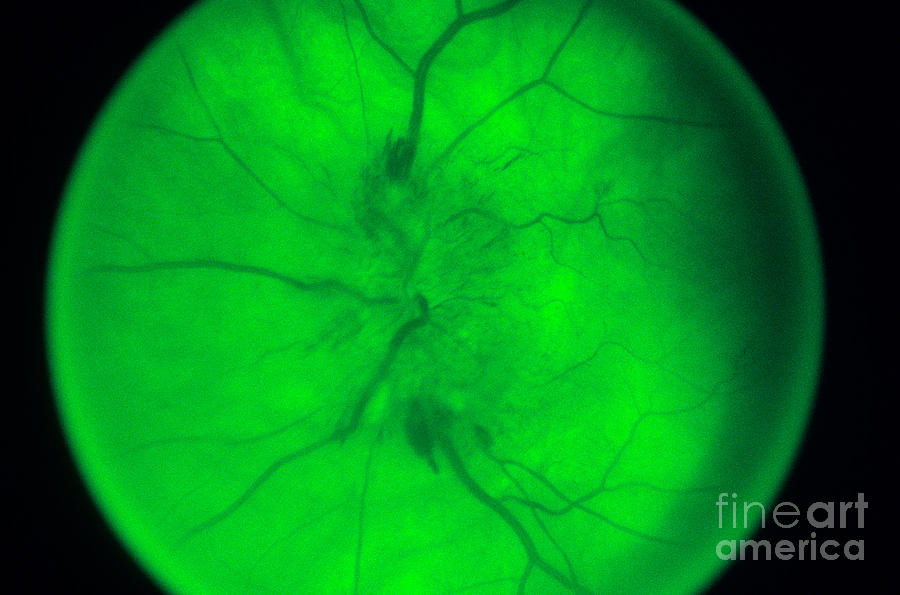 Papilloedema Of The Eye Photograph by Science Source