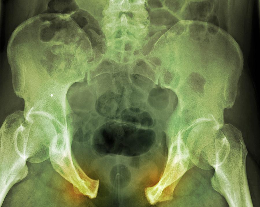 Pelvic Fracture X Ray Photograph By Du Cane Medical Imaging Ltd Pixels