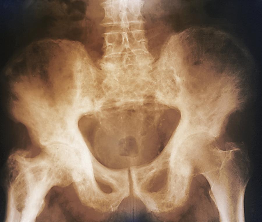 Pelvis In Paget S Disease X Ray Photograph By Zephyr