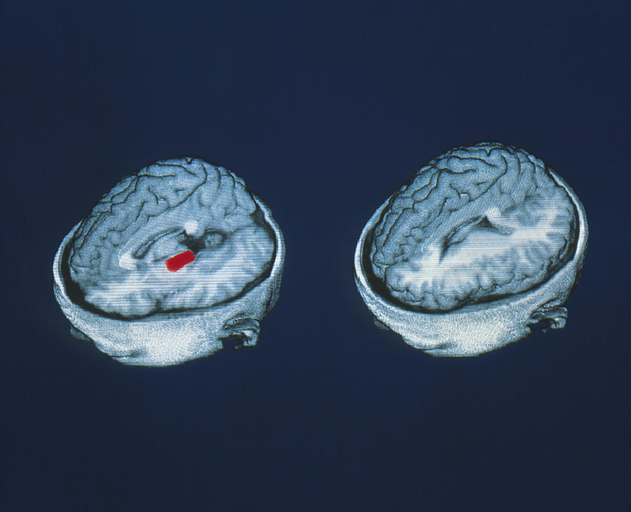 Pet Brain Scans Showing Mistaken Memory Of Words Photograph by Eric Reiman, University Of Arizona