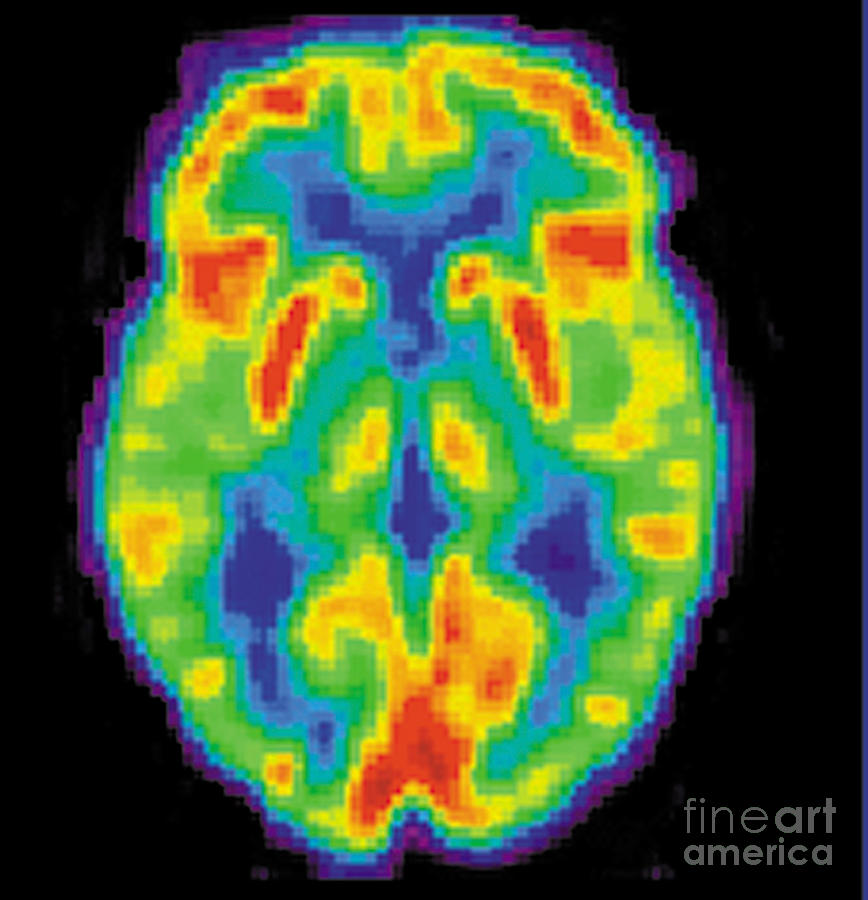 Diagnostic Photograph - Pet Scan Of 80-year-old Brain, 2 Of 2 by Science Source