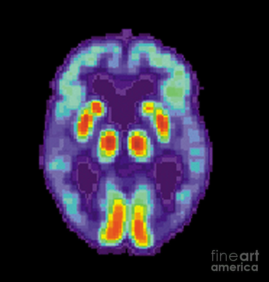 Pet Scan Of Alzheimers Disease Brain, 2 Photograph by Science Source
