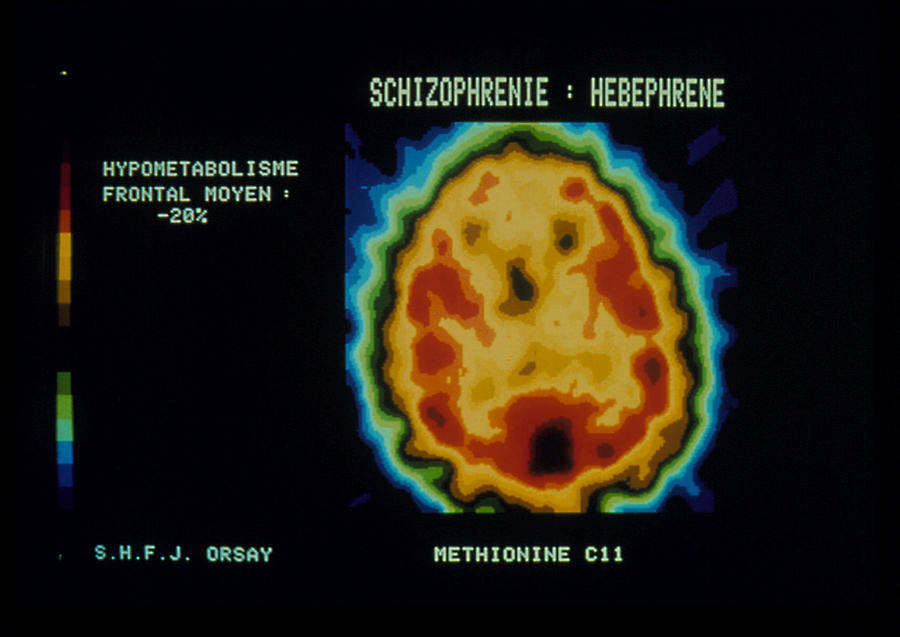 Mental Illness Photograph - Pet Scan Of Brain Of Person With Schizophrenia by Cnri Schizophrenia. Coloured Pet (positron Emission